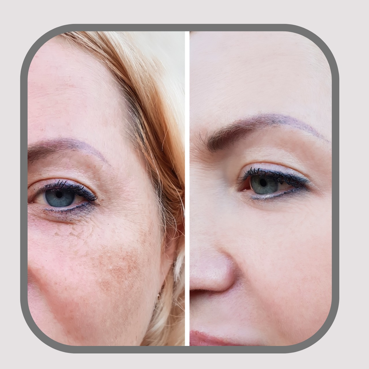 Melasma, Pigmentation, Birth Mark, Sun Damage Removal