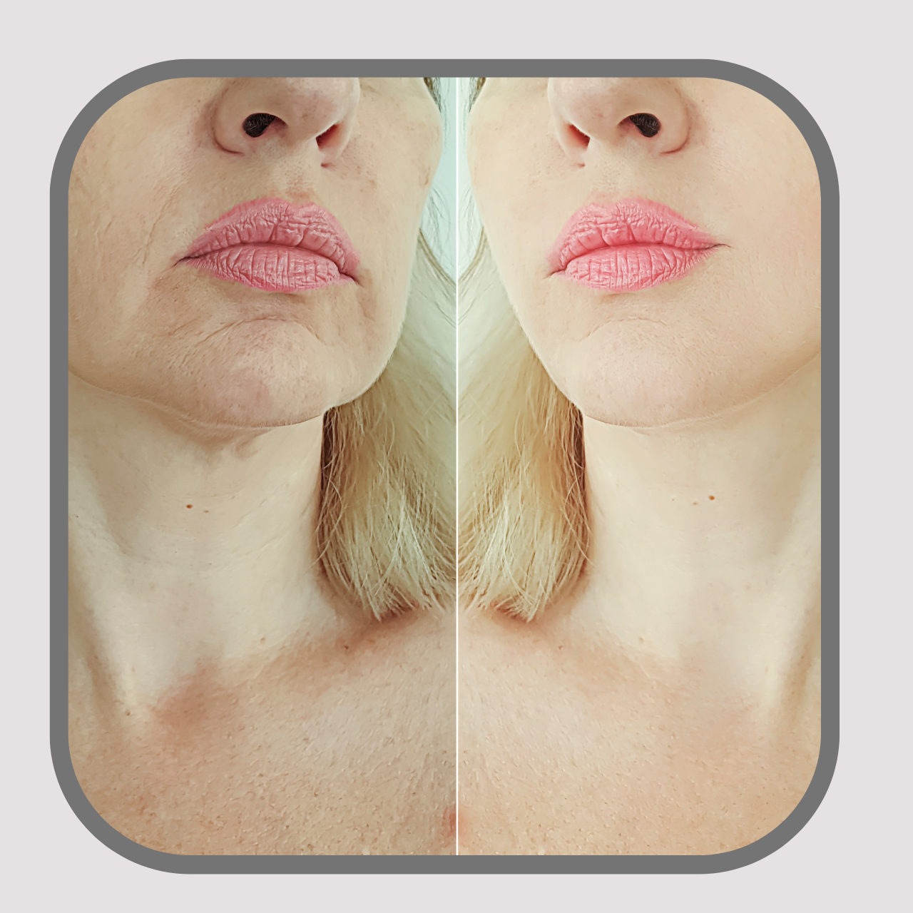 Skin Rejuvenation