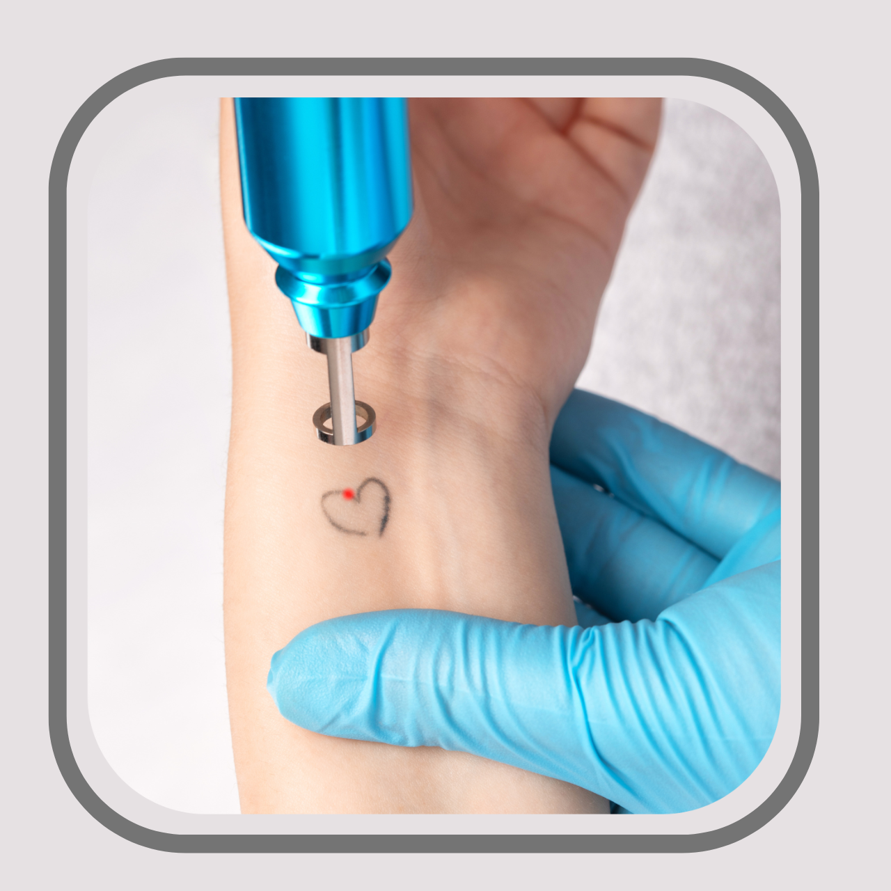 Tattoo Laser Removal -Starting from R200 per session