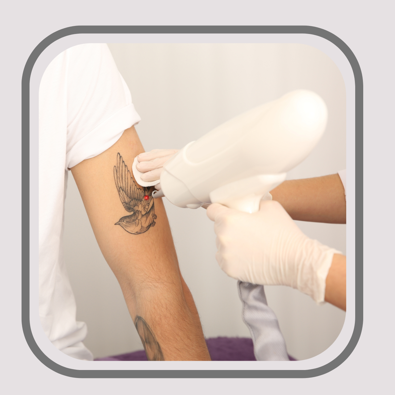 Tattoo Laser Removal -Starting from R200 per session