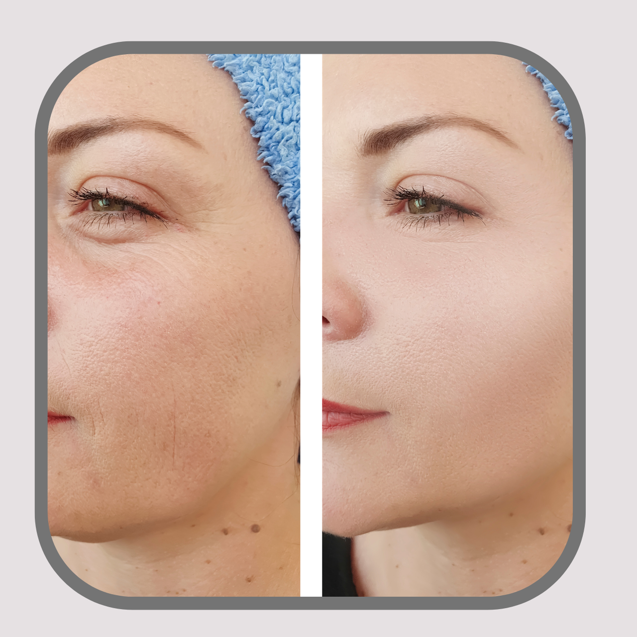 Wrinkle Therapy