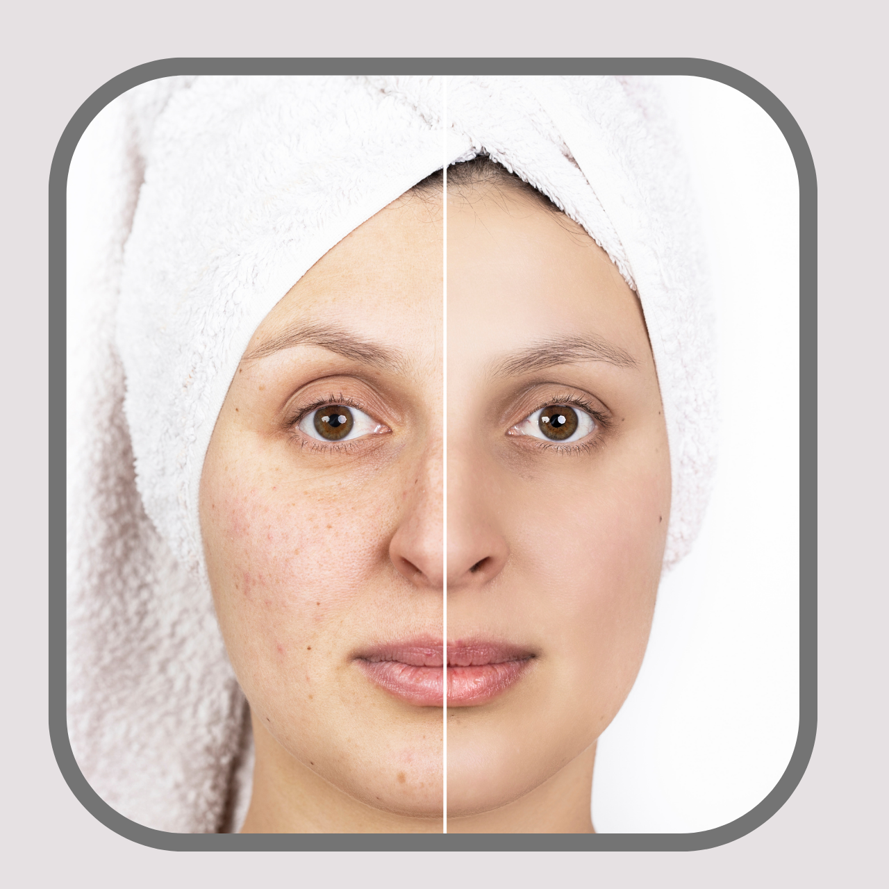 Melasma, Pigmentation, Birth Mark, Sun Damage Removal